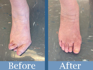 Before and after bunion surgery