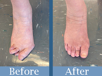 Overlapping and Underlapping Toes - Kevin J. Powers, DPMKevin J. Powers, DPM