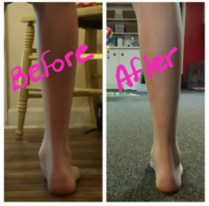 HyProCure Results for Flat Feet