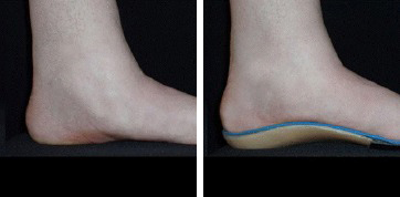 custom orthotics for feet